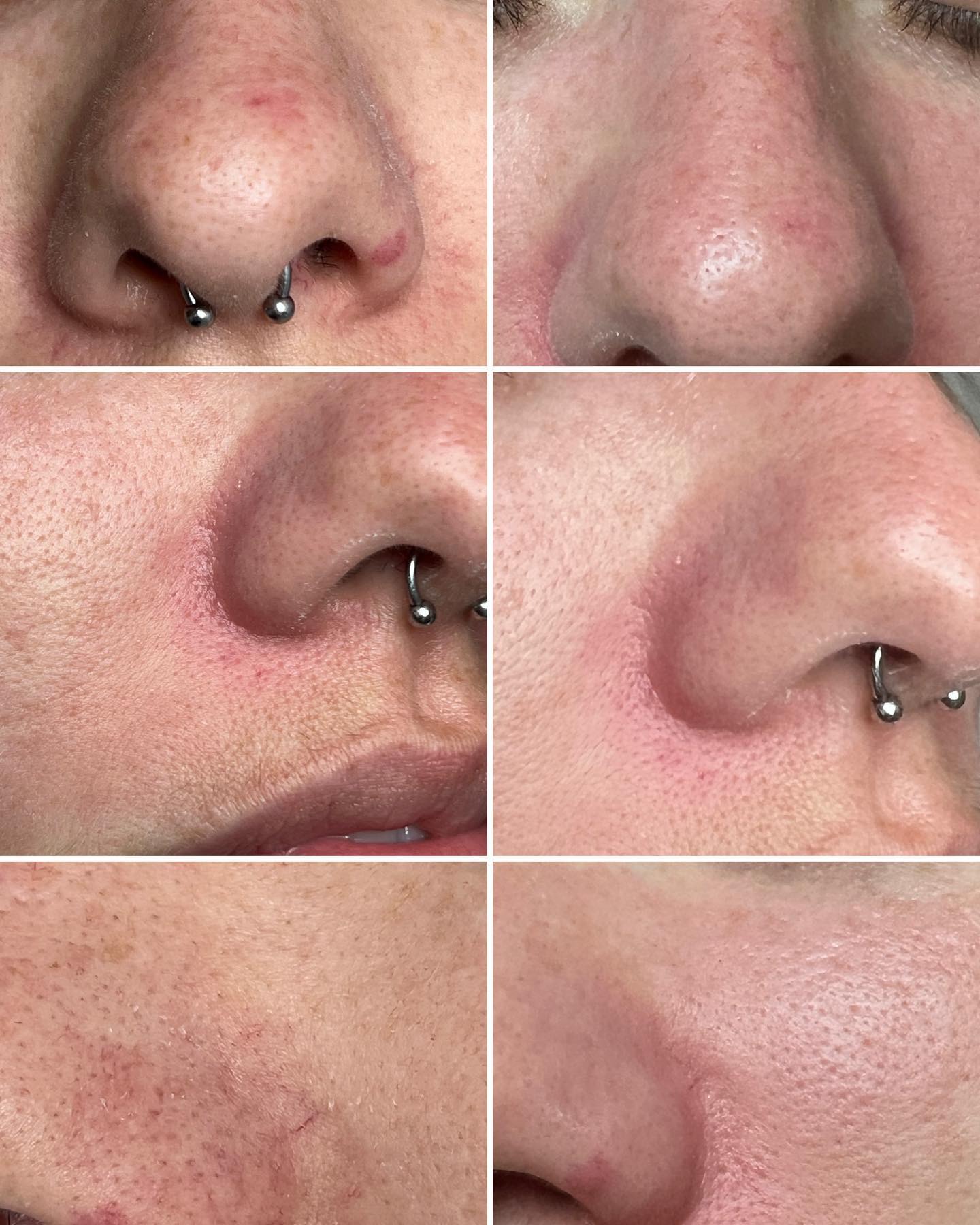 Antes y después de un tratamiento facial: menos rojez y textura de piel alrededor de la nariz