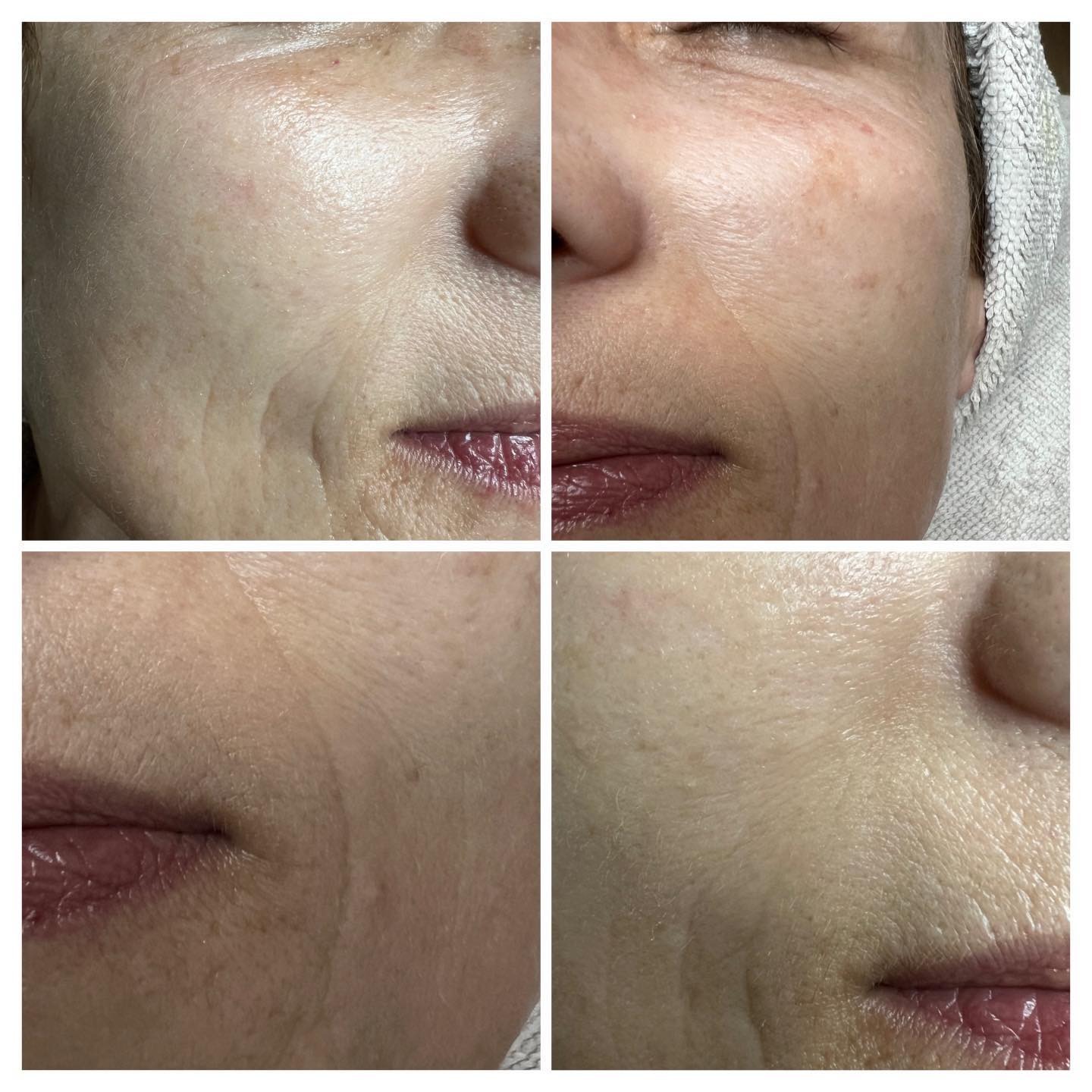 Antes y después de un tratamiento facial, con las líneas de expresión alrededor de la boca visiblemente más suaves